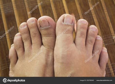 Ugly Feet Pictures, Images and Stock Photos